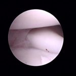 elbow joint - arthroscopy