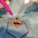lamelární keratectomie -chirurgické odstranění změněné rohovky